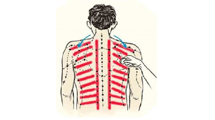 Tata cara pengobatan kerokan. © jogjaupdate.com