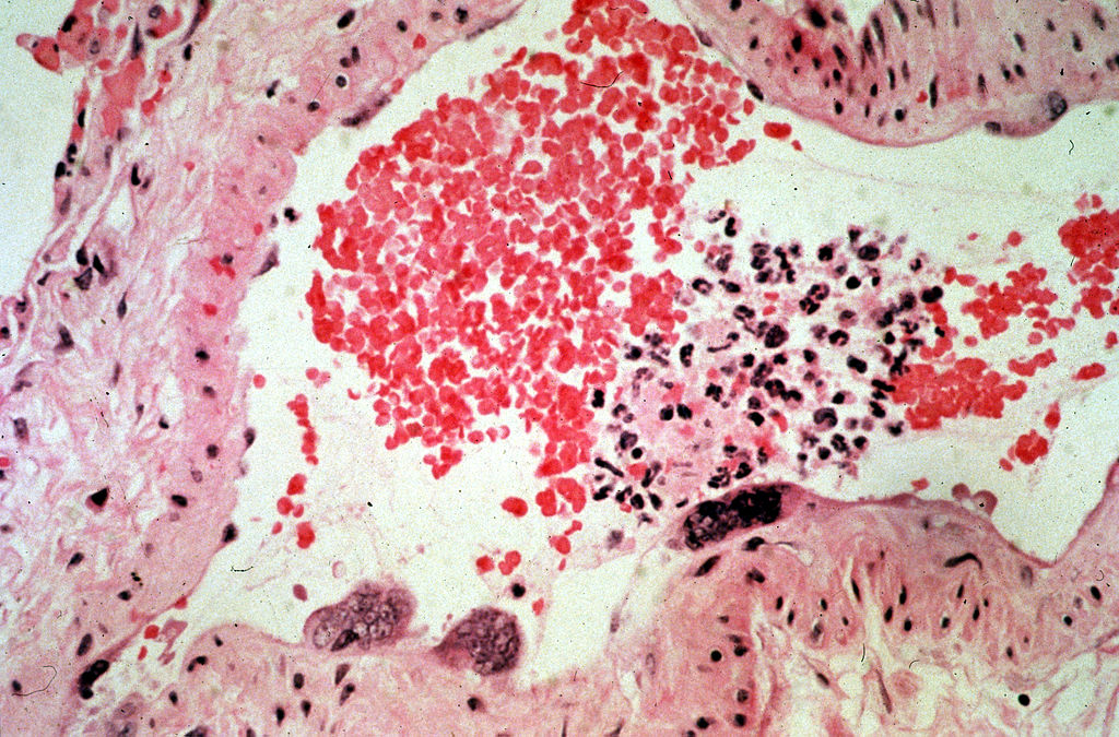 Ilustasi pembuluh darah dengan virus Hendra | Wikimedia Commons